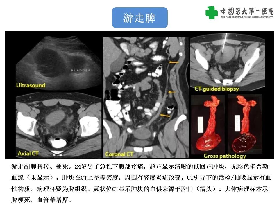 影像PPT - 【PPT】腹部及盆腔脾种植不典型表现、诊断陷阱及鉴别诊断-39