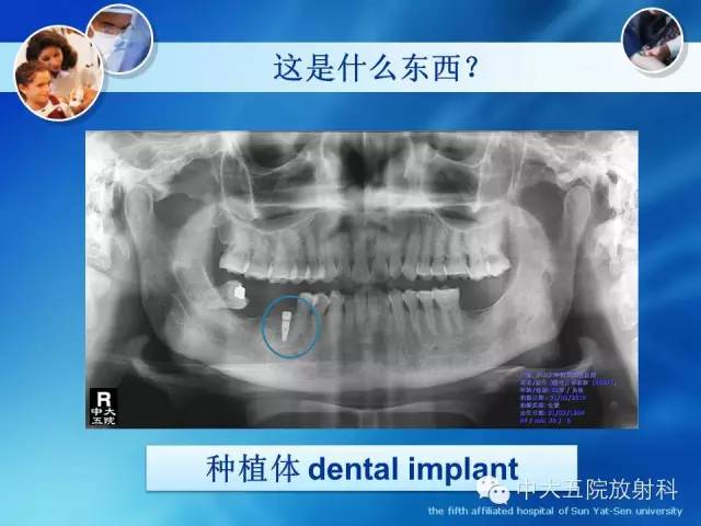 影像PPT - 【PPT】种植牙CT照相与报告书写-2