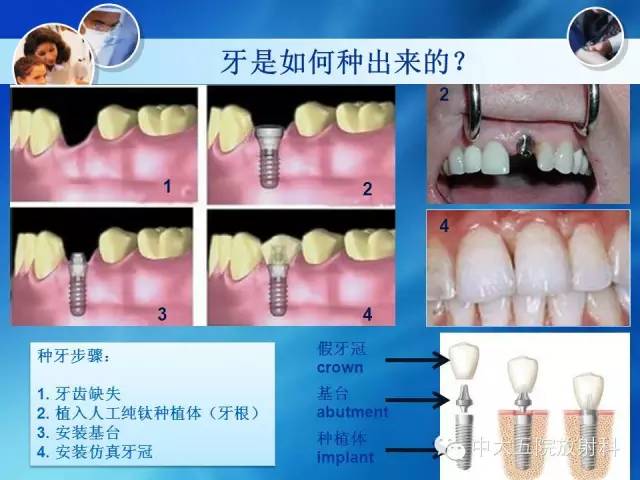 影像PPT - 【PPT】种植牙CT照相与报告书写-4