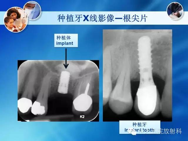 影像PPT - 【PPT】种植牙CT照相与报告书写-5