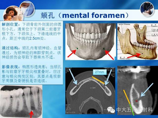 影像PPT - 【PPT】种植牙CT照相与报告书写-8