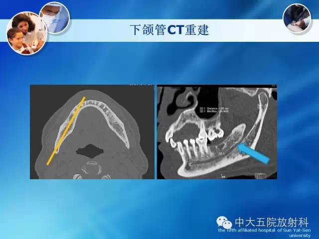 影像PPT - 【PPT】种植牙CT照相与报告书写-10