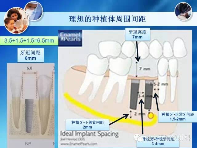 影像PPT - 【PPT】种植牙CT照相与报告书写-14