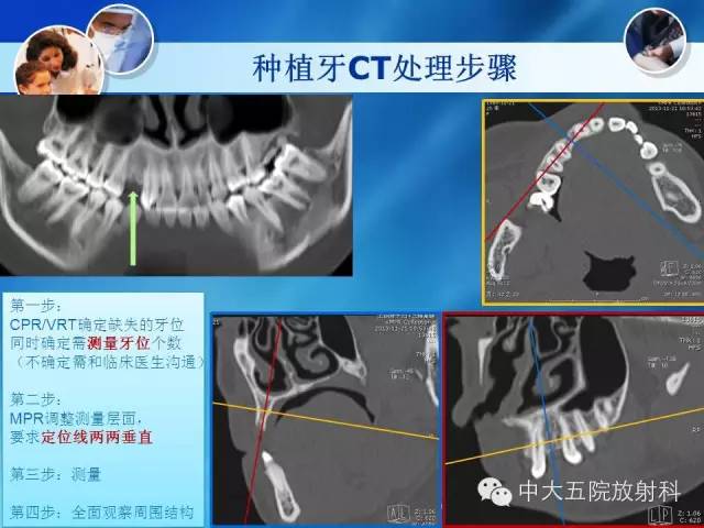 影像PPT - 【PPT】种植牙CT照相与报告书写-15