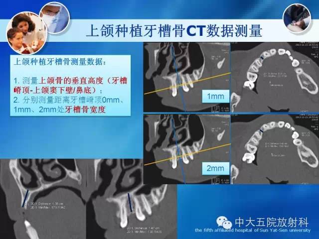 影像PPT - 【PPT】种植牙CT照相与报告书写-16