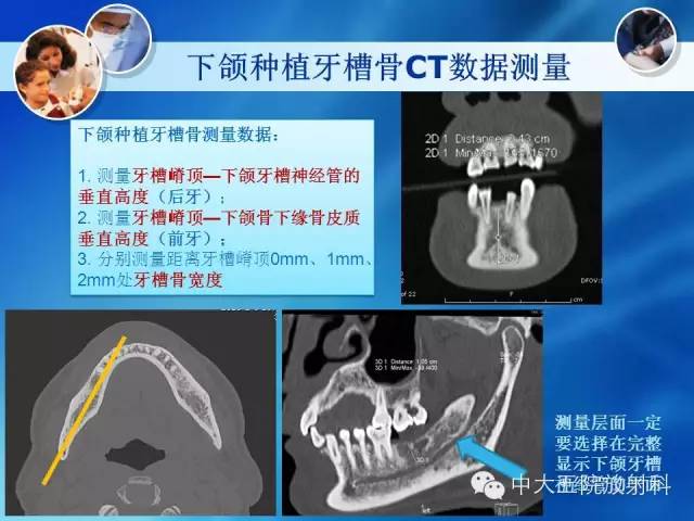 影像PPT - 【PPT】种植牙CT照相与报告书写-17