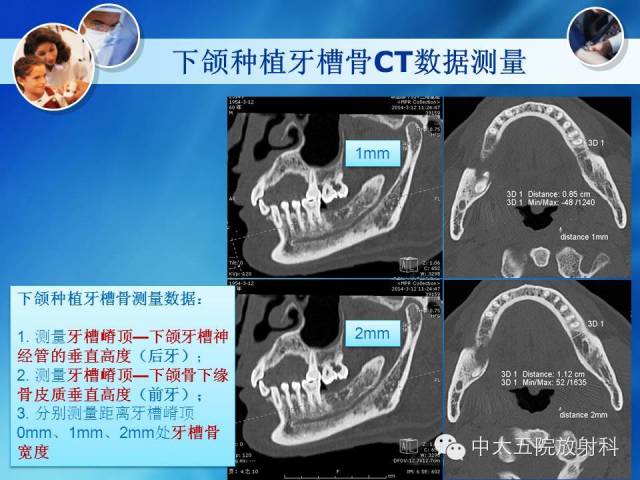 影像PPT - 【PPT】种植牙CT照相与报告书写-18