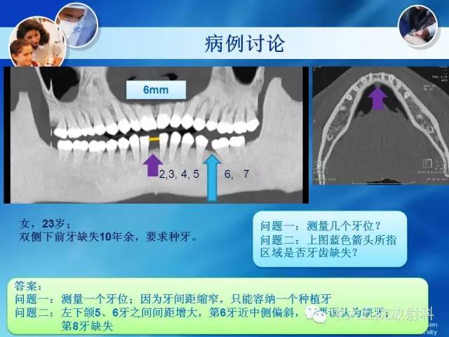 影像PPT - 【PPT】种植牙CT照相与报告书写-19