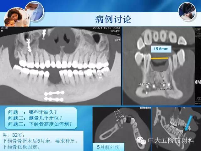 影像PPT - 【PPT】种植牙CT照相与报告书写-20