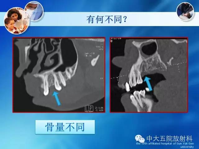 影像PPT - 【PPT】种植牙CT照相与报告书写-22