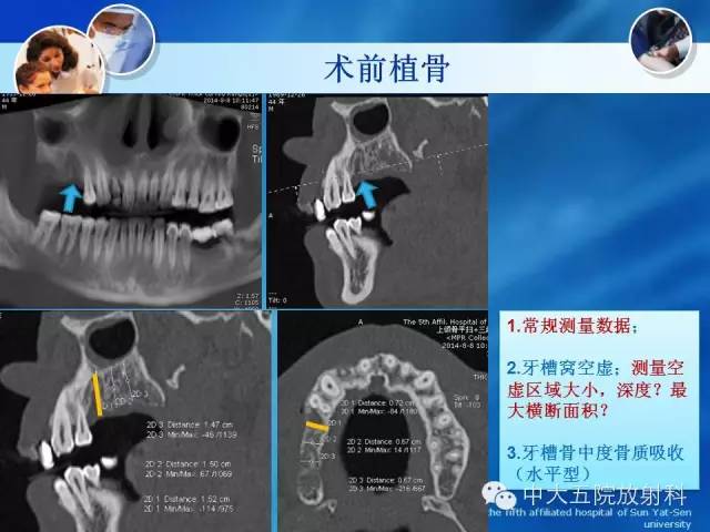影像PPT - 【PPT】种植牙CT照相与报告书写-23