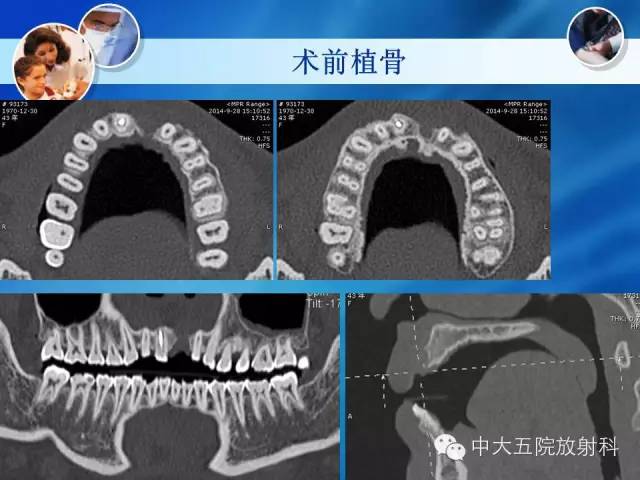 影像PPT - 【PPT】种植牙CT照相与报告书写-24