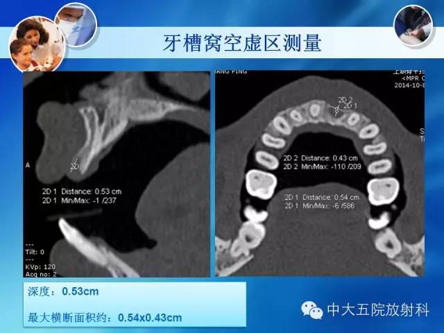 影像PPT - 【PPT】种植牙CT照相与报告书写-25