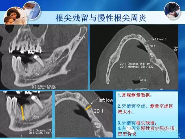 影像PPT - 【PPT】种植牙CT照相与报告书写-27
