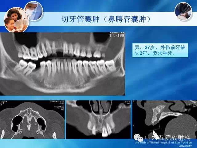影像PPT - 【PPT】种植牙CT照相与报告书写-28