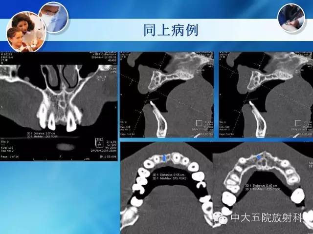 影像PPT - 【PPT】种植牙CT照相与报告书写-29
