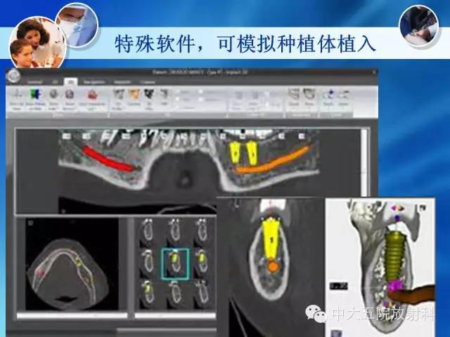 影像PPT - 【PPT】种植牙CT照相与报告书写-32