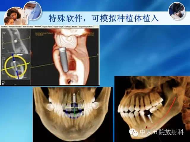 影像PPT - 【PPT】种植牙CT照相与报告书写-33