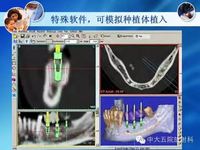 影像PPT - 【PPT】种植牙CT照相与报告书写-34