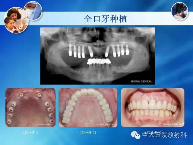 影像PPT - 【PPT】种植牙CT照相与报告书写-35