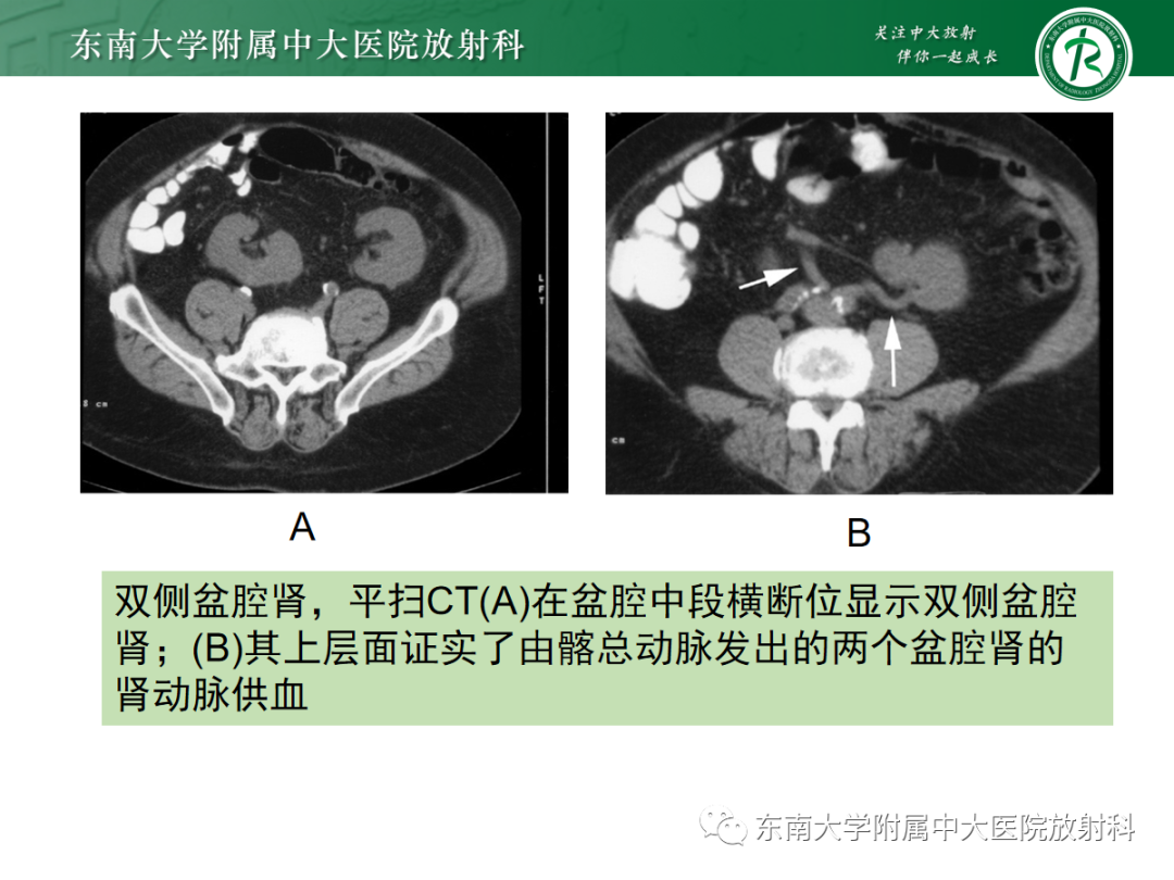 影像PPT - 【PPT】肾脏先天性发育异常-16