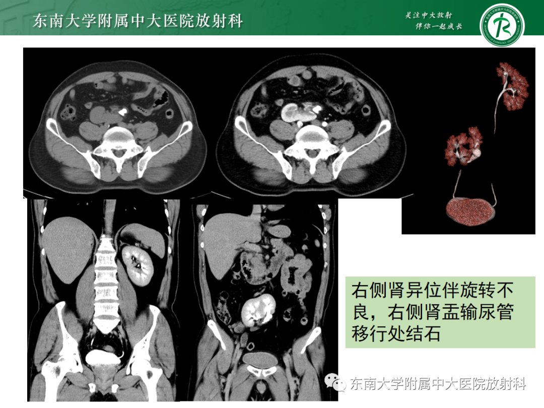 影像PPT - 【PPT】肾脏先天性发育异常-3