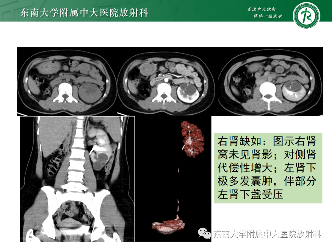 影像PPT - 【PPT】肾脏先天性发育异常-12