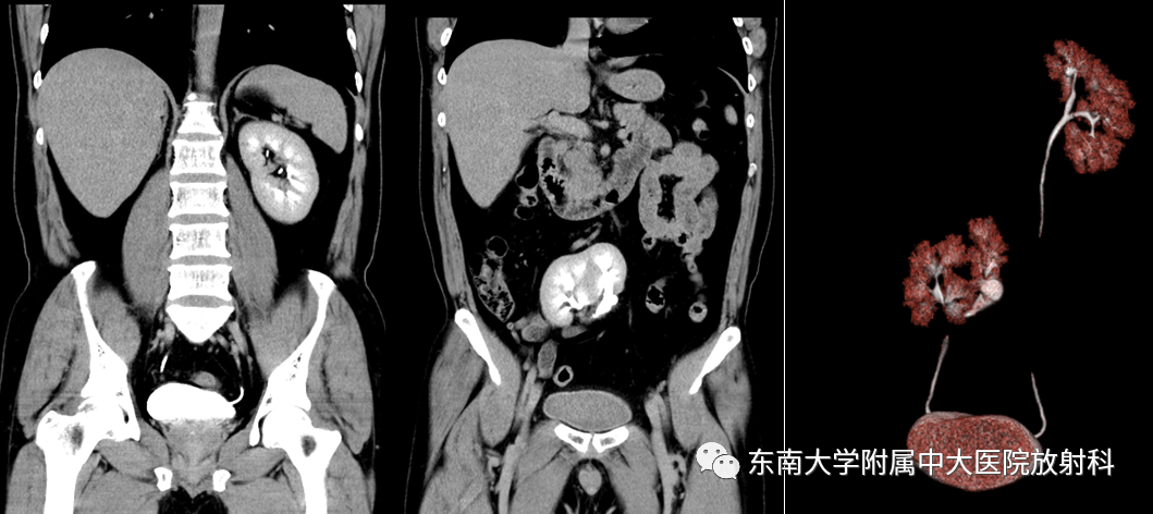 影像PPT - 【PPT】肾脏先天性发育异常-2