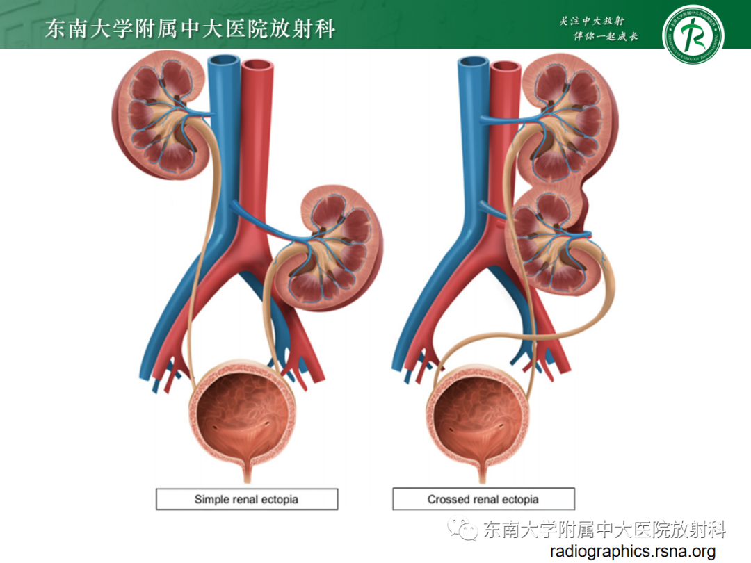 影像PPT - 【PPT】肾脏先天性发育异常-14