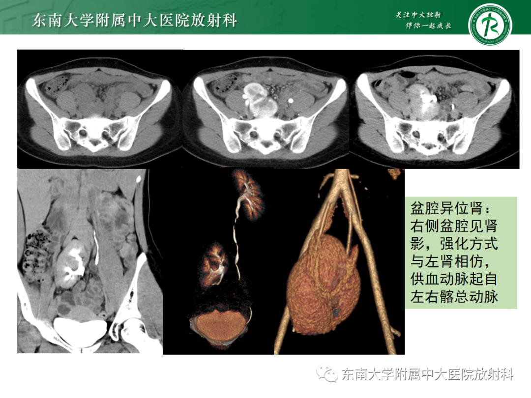 影像PPT - 【PPT】肾脏先天性发育异常-17