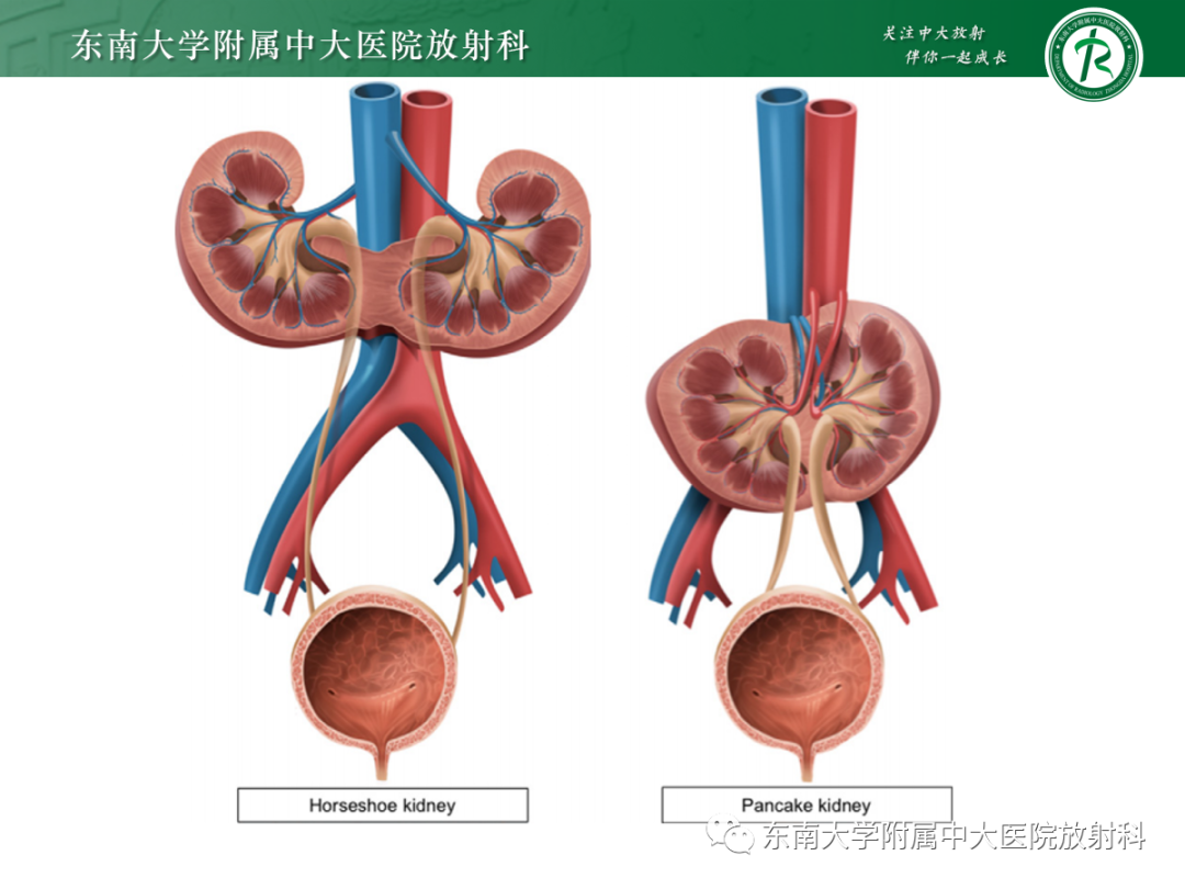 影像PPT - 【PPT】肾脏先天性发育异常-23