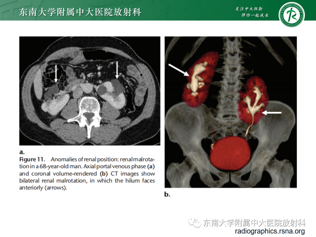 影像PPT - 【PPT】肾脏先天性发育异常-21
