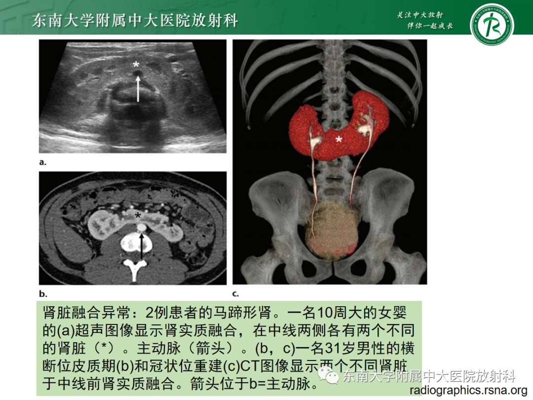 影像PPT - 【PPT】肾脏先天性发育异常-25