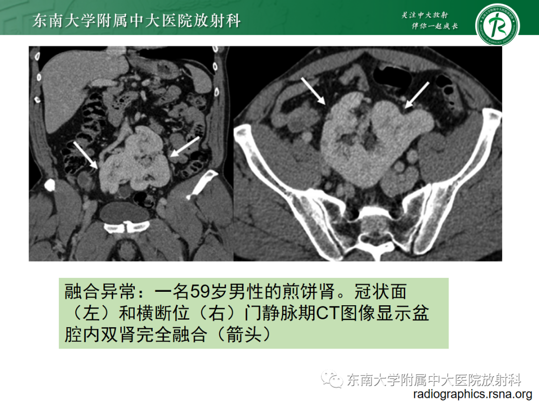 影像PPT - 【PPT】肾脏先天性发育异常-26