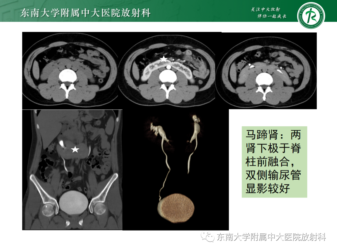影像PPT - 【PPT】肾脏先天性发育异常-27
