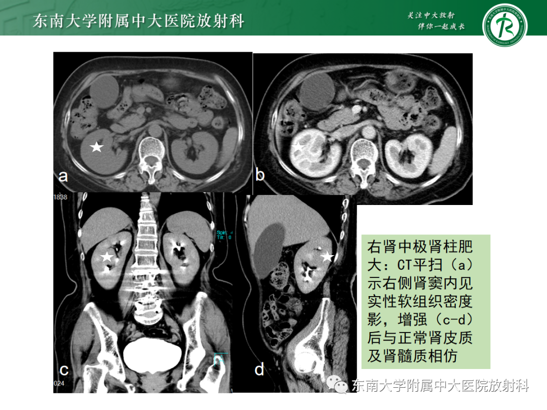 影像PPT - 【PPT】肾脏先天性发育异常-32