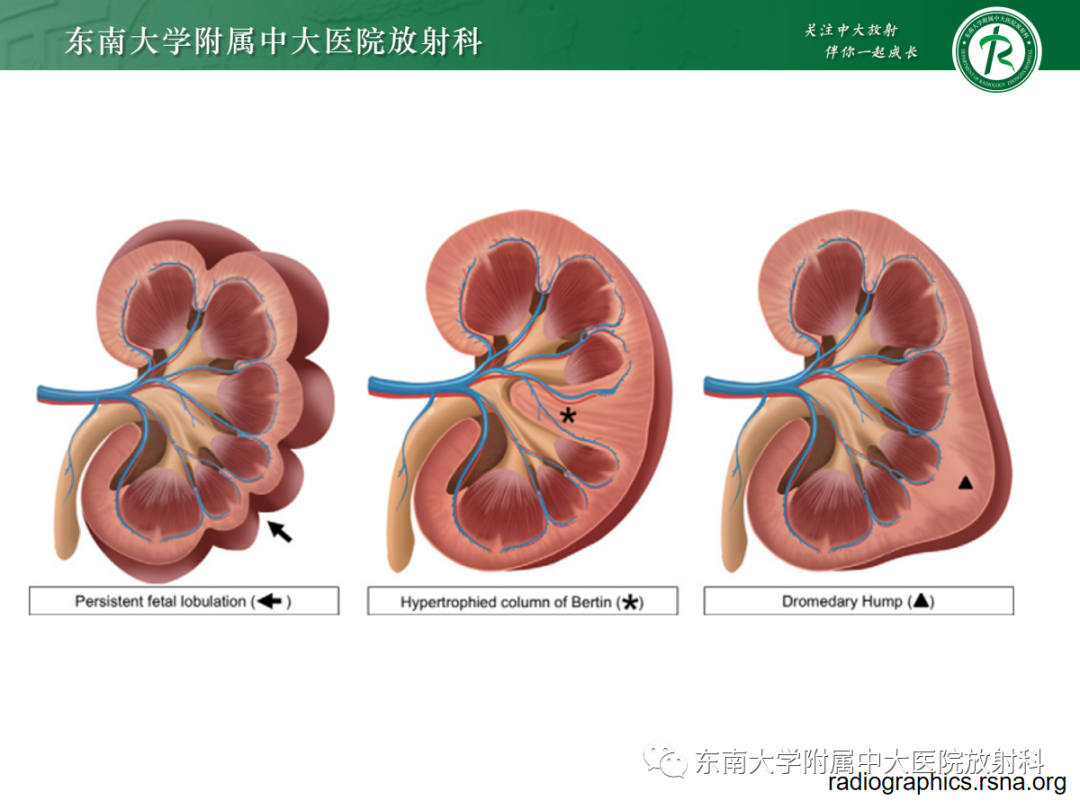 影像PPT - 【PPT】肾脏先天性发育异常-30