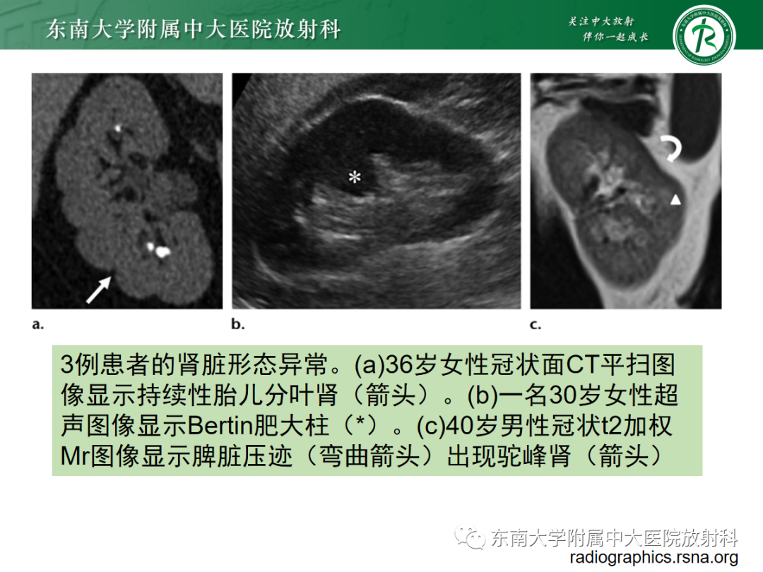影像PPT - 【PPT】肾脏先天性发育异常-31