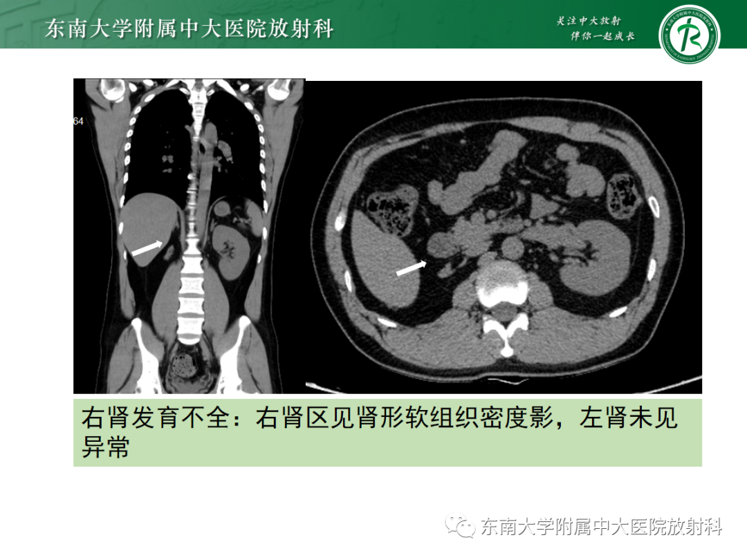 影像PPT - 【PPT】肾脏先天性发育异常-35