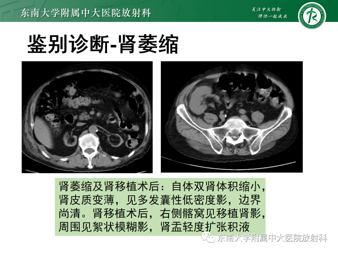 影像PPT - 【PPT】肾脏先天性发育异常-36