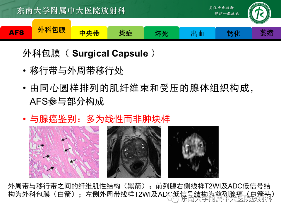 影像PPT - 【PPT】易误诊为前列腺癌的正常结构及良性病变-4