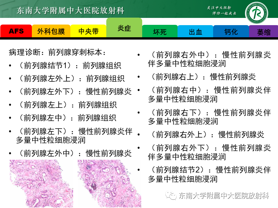 影像PPT - 【PPT】易误诊为前列腺癌的正常结构及良性病变-8