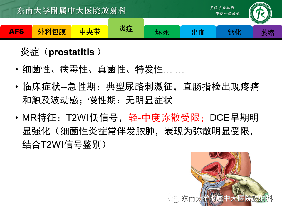 影像PPT - 【PPT】易误诊为前列腺癌的正常结构及良性病变-6