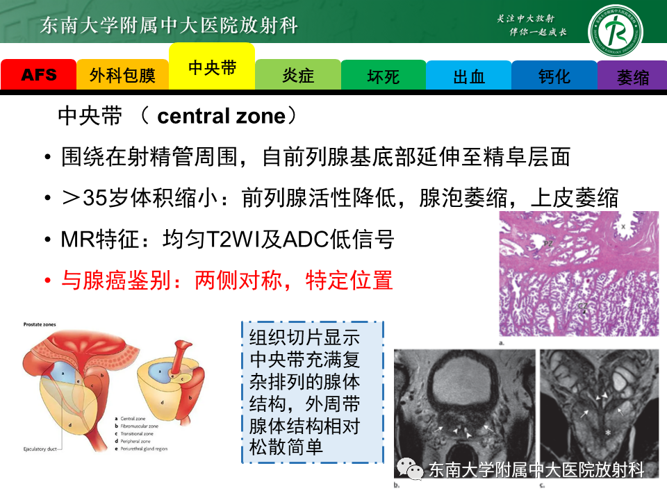 影像PPT - 【PPT】易误诊为前列腺癌的正常结构及良性病变-5