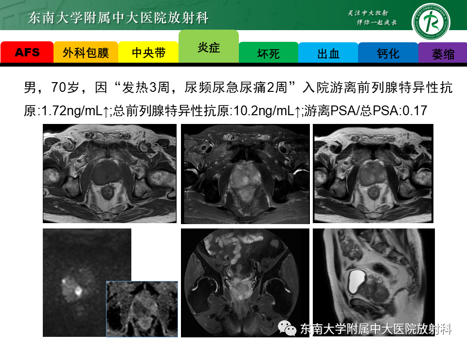 影像PPT - 【PPT】易误诊为前列腺癌的正常结构及良性病变-7
