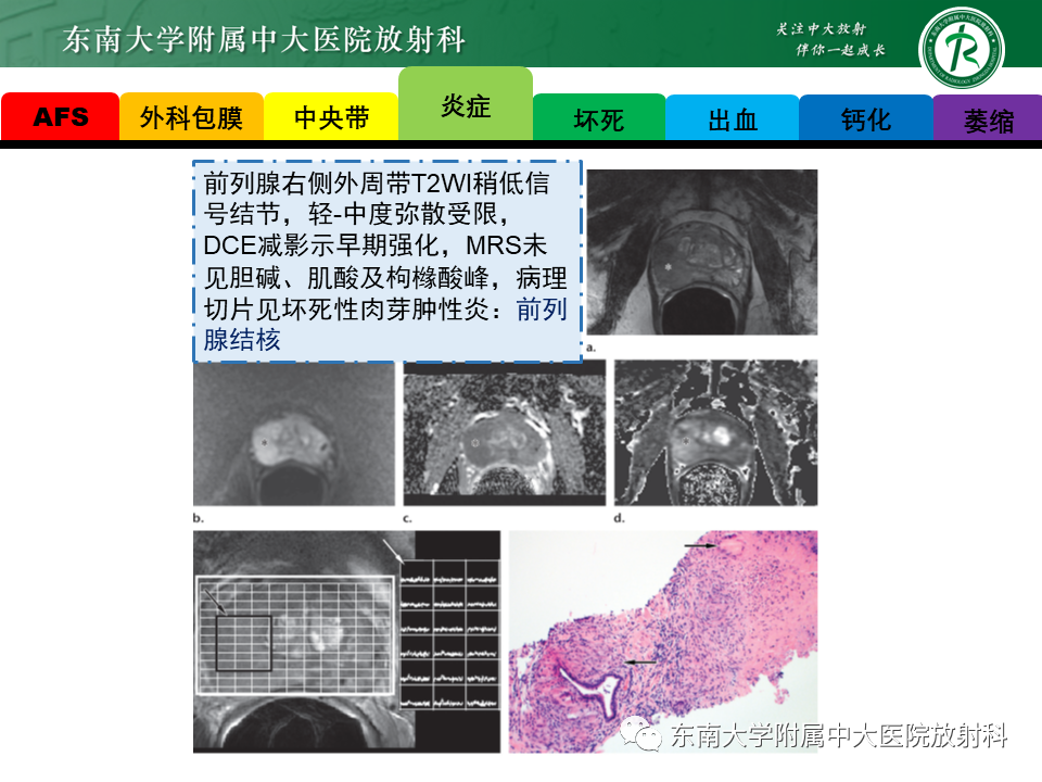 影像PPT - 【PPT】易误诊为前列腺癌的正常结构及良性病变-11