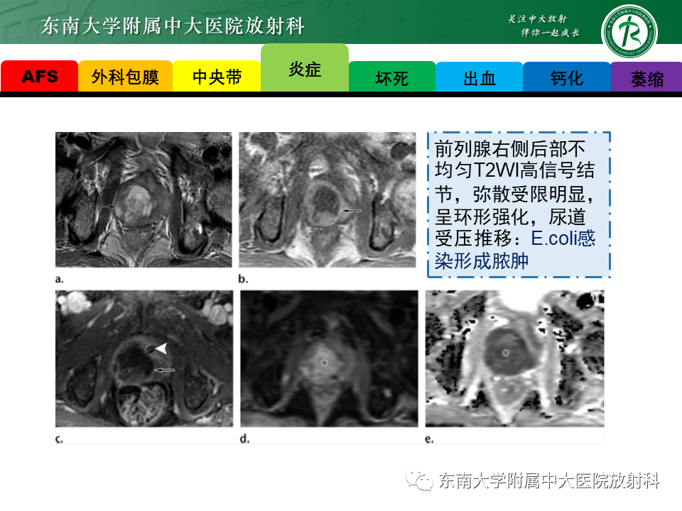影像PPT - 【PPT】易误诊为前列腺癌的正常结构及良性病变-9