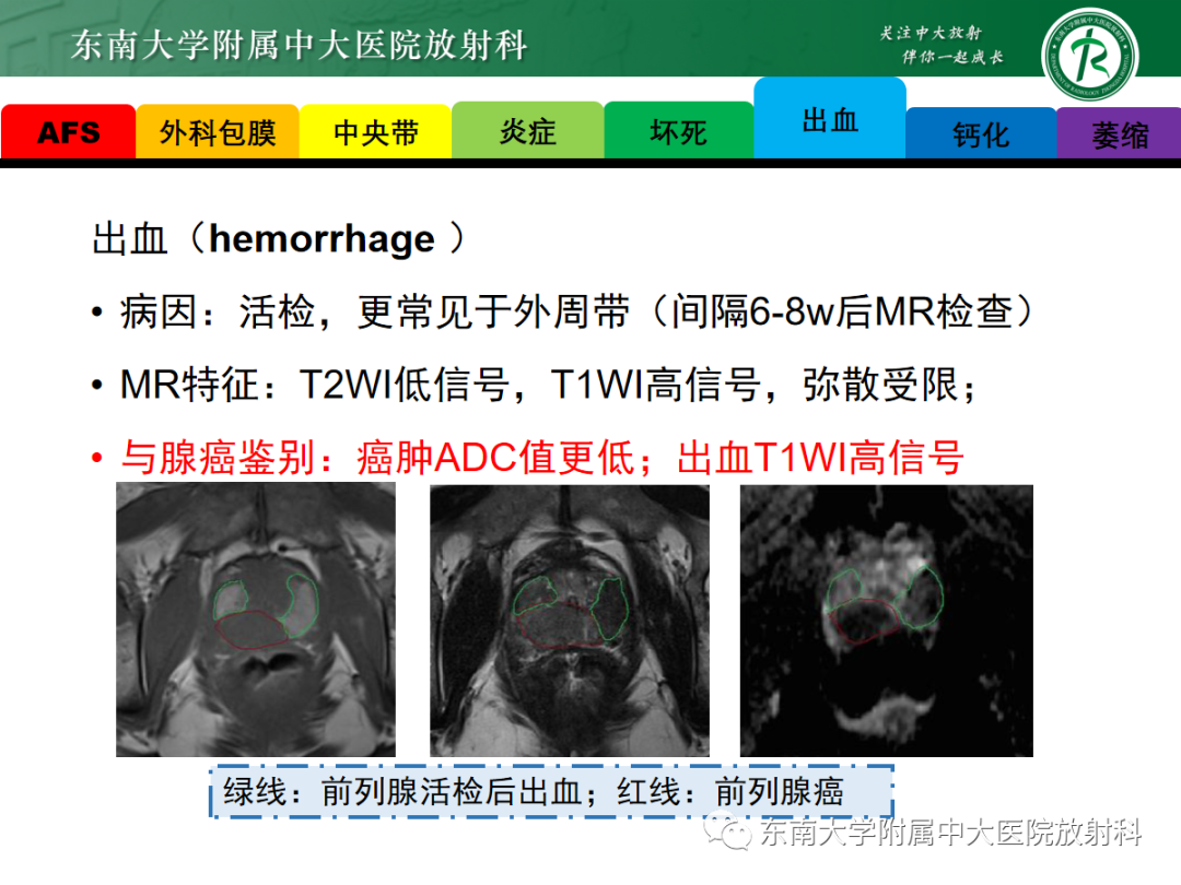 影像PPT - 【PPT】易误诊为前列腺癌的正常结构及良性病变-13