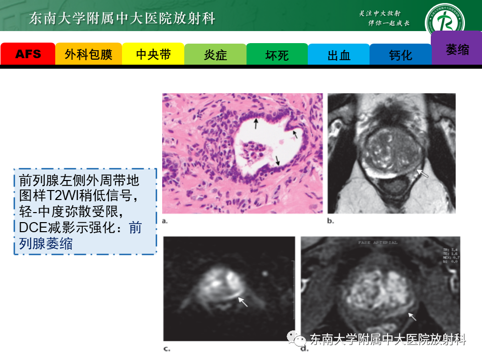 影像PPT - 【PPT】易误诊为前列腺癌的正常结构及良性病变-16