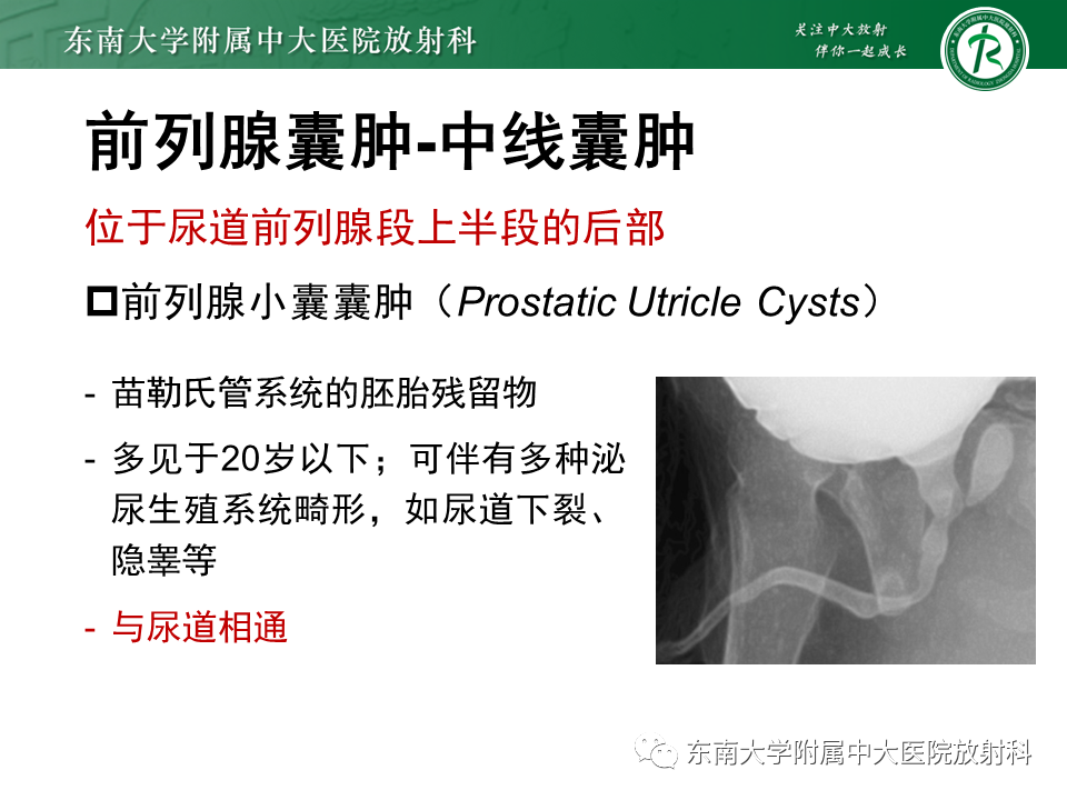 影像PPT - 【PPT】易误诊为前列腺癌的正常结构及良性病变-19